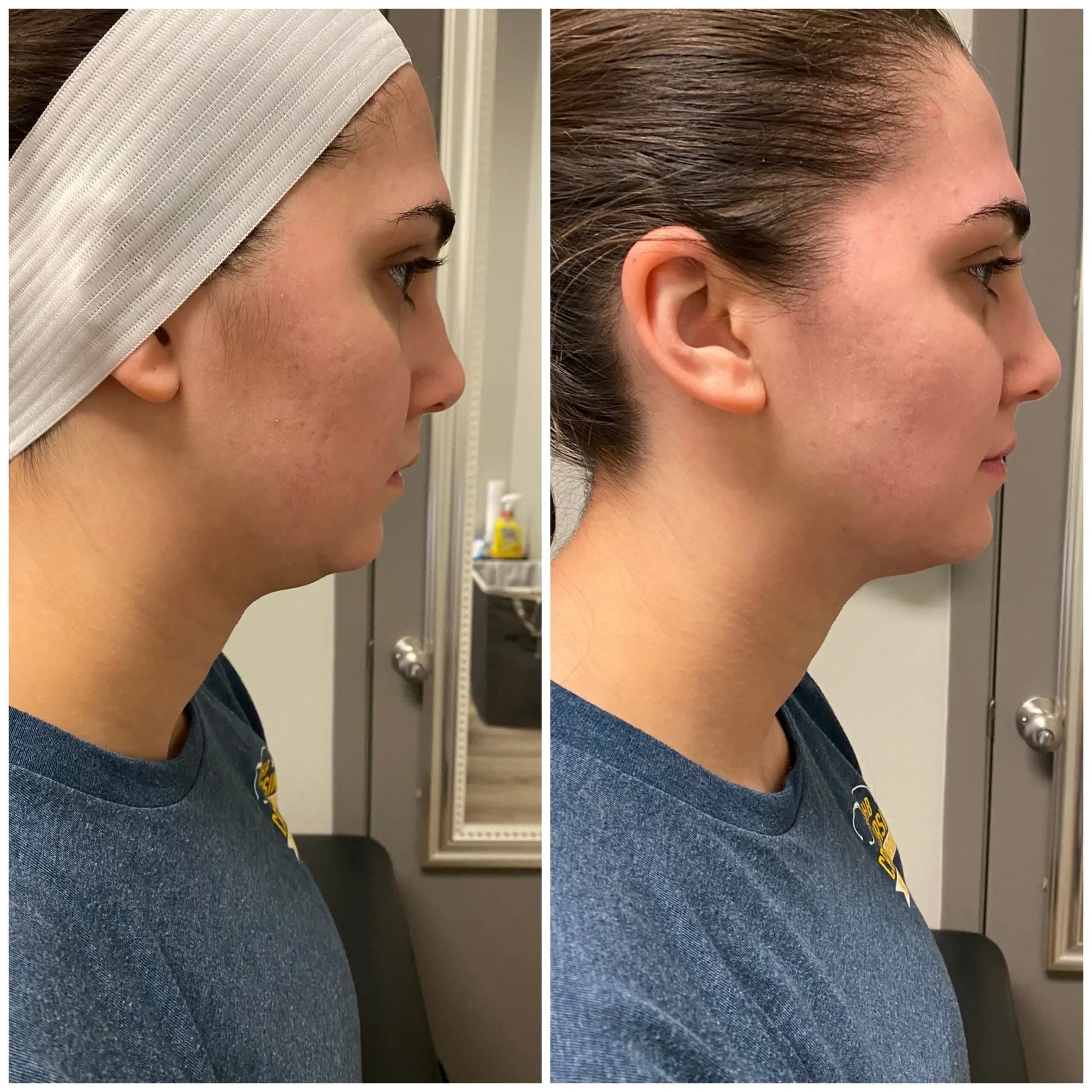 Neveskin facial toning before and after