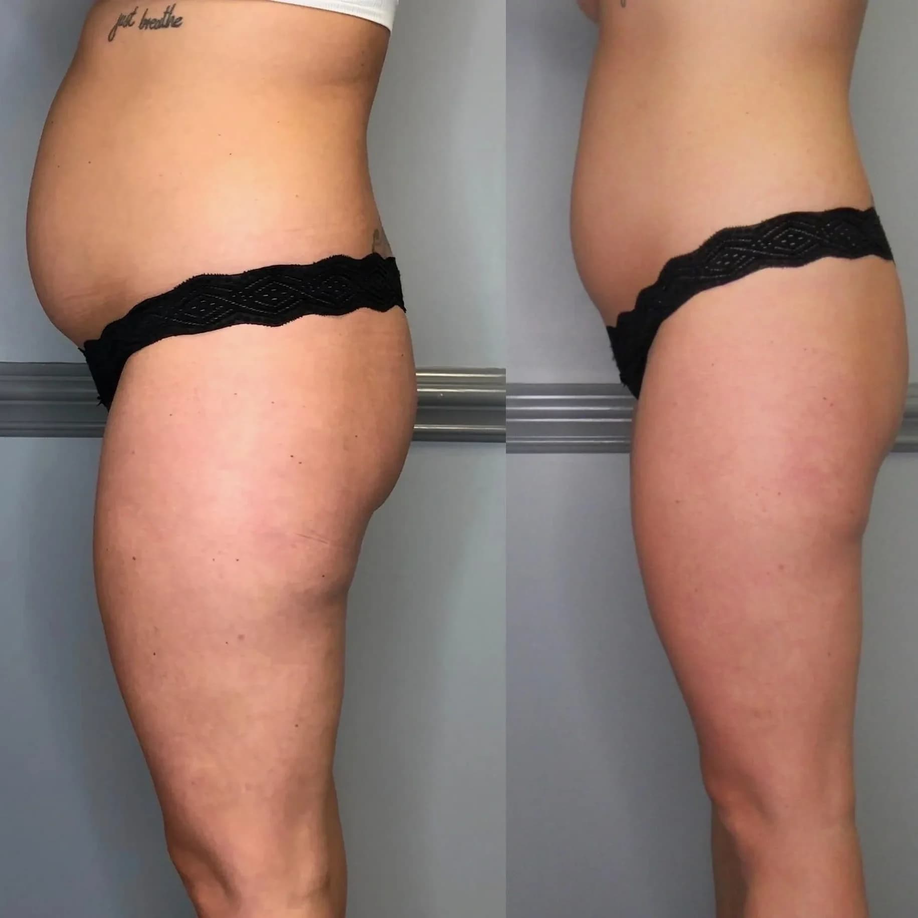 Neveskin body contouring before and after — side profile
